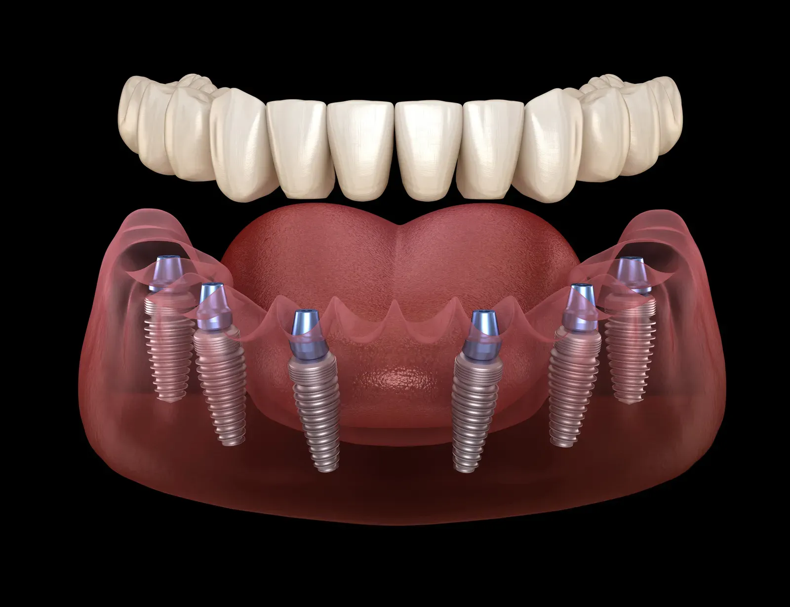 Photo related to dental implant