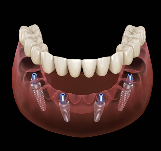 all on 4 dental implants charlotte