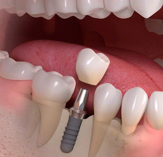single dental implant charlotte nc