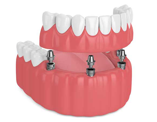 implant retained dentures charlotte nc