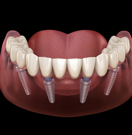 all on 4 implants charlotte nc