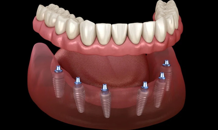 Benefits of Full Mouth Dental Implants