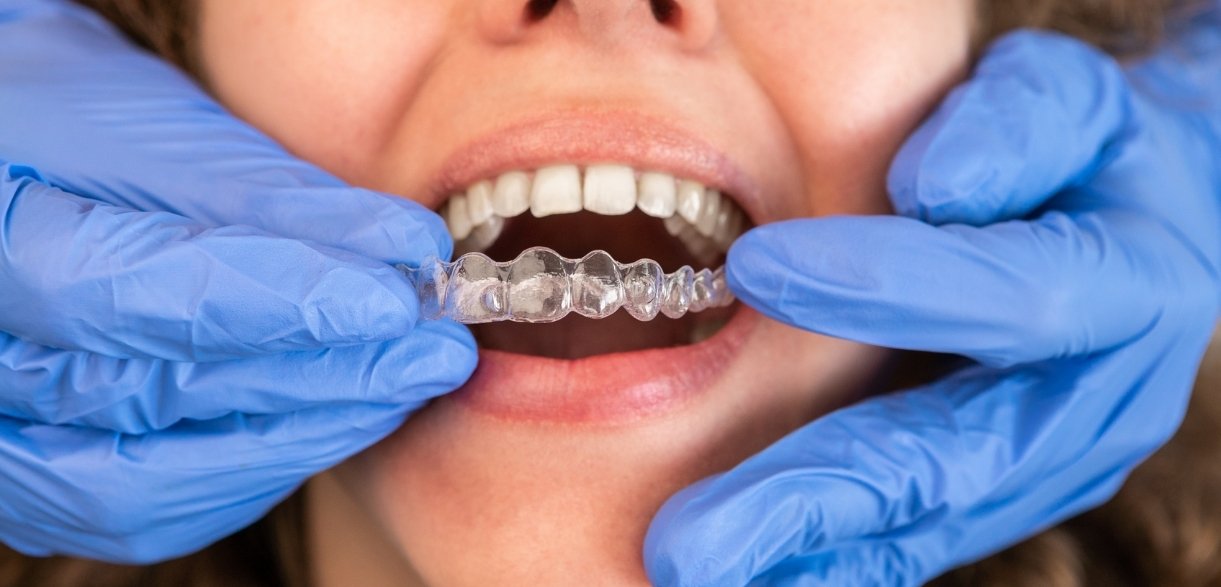 how long Invisalign treatment takes and the key factors that affect your timeline