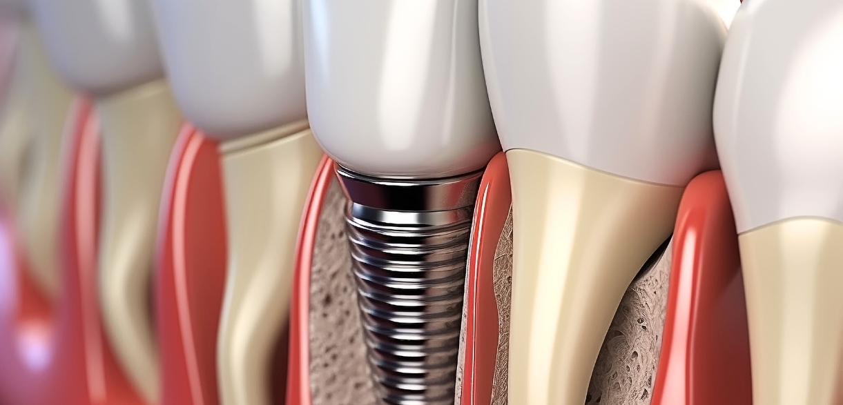 pain from dental implant surgery