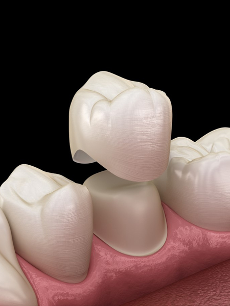 Dental Crowns in Charlotte NC