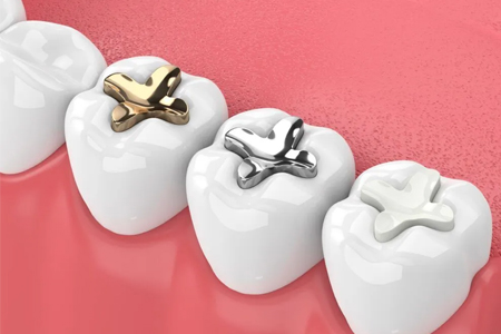 Dental filling in Charlotte NC