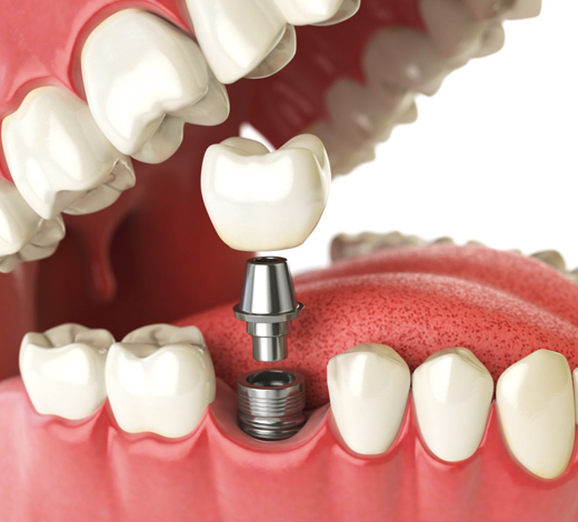 Single Tooth Implants and Bridges in Charlotte NC