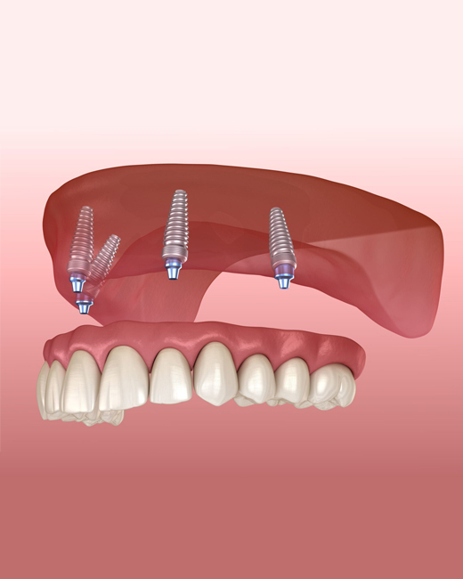 Snap-In Implant Dentures in Charlotte NC