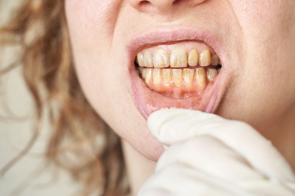 How Can a Dentist Help Swollen Gums Without Pain?