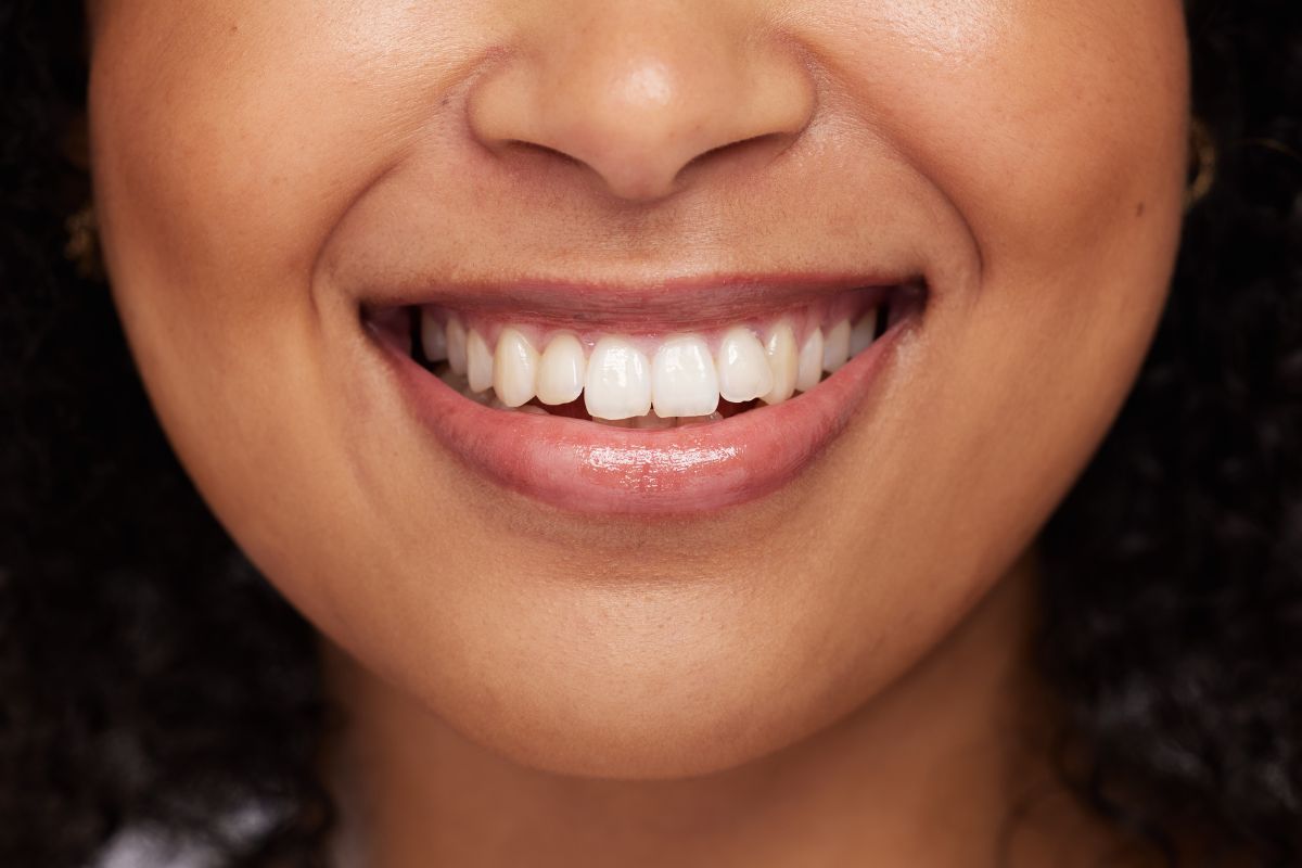 How Long Does Teeth Whitening Lasts? Dentist's Guide